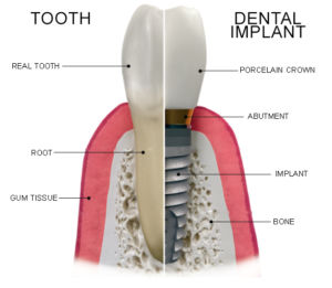 Beaumont Dental Center | Dental Implants | Teeth Replacement